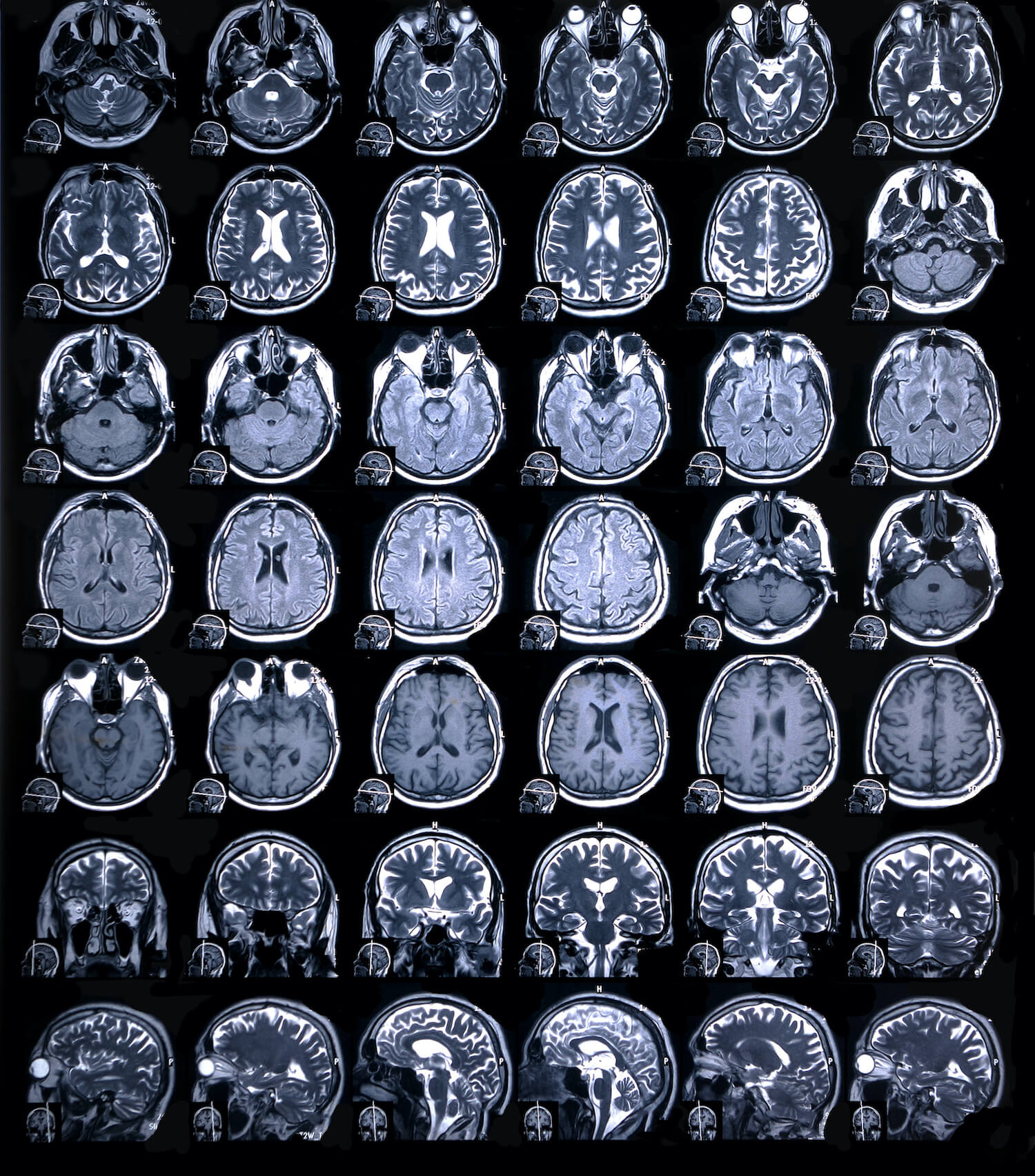 TRACK-TBI Study Focuses on Effective Treatment of Traumatic Brain Injury